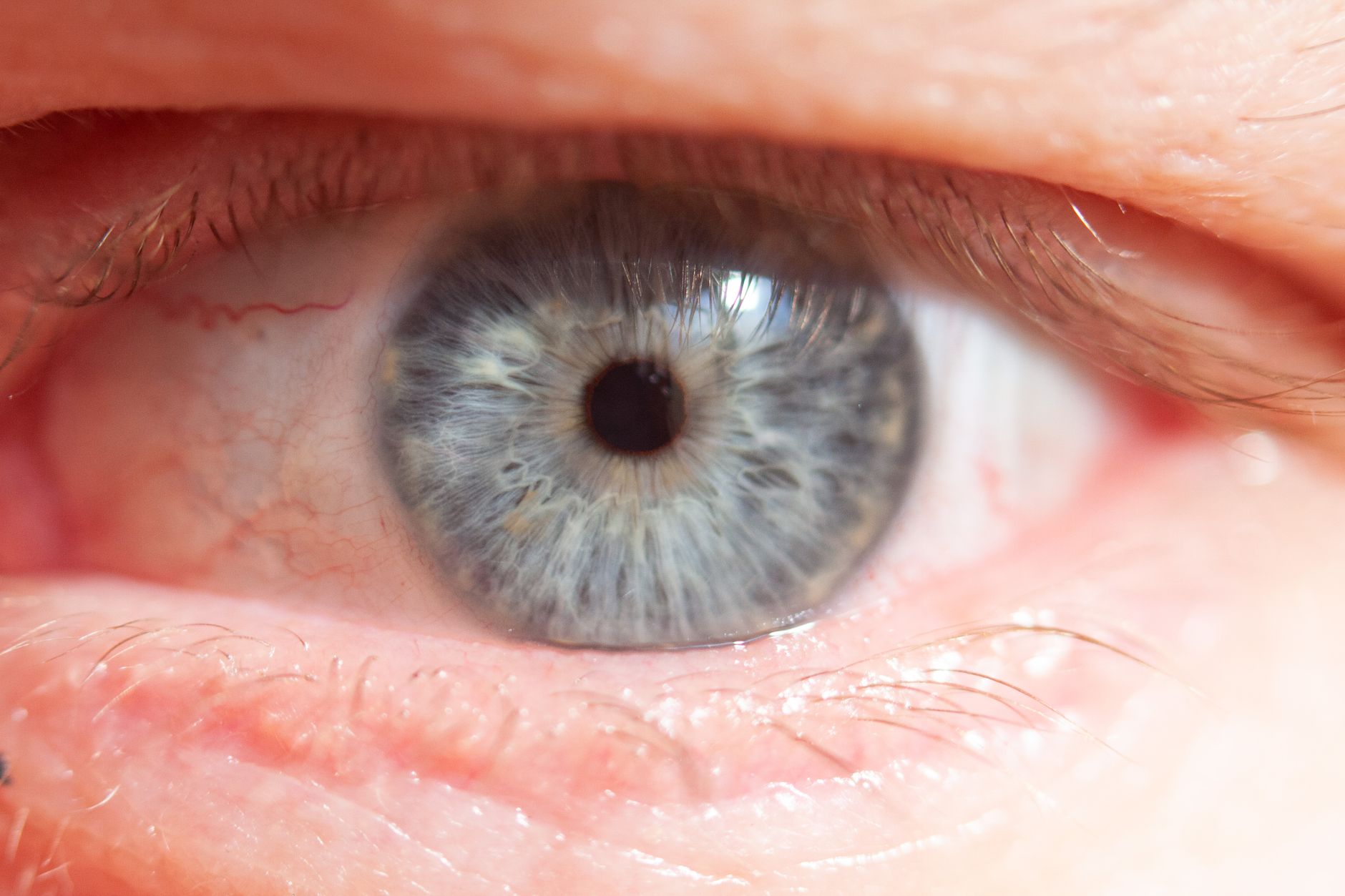 Cataracts in Seniors: Causes, Symptoms & Treatment